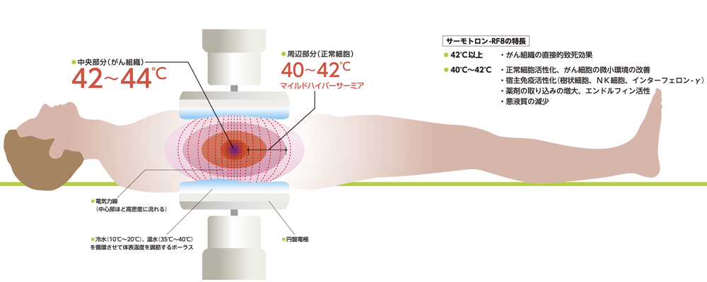 ハイパーサーミアとは