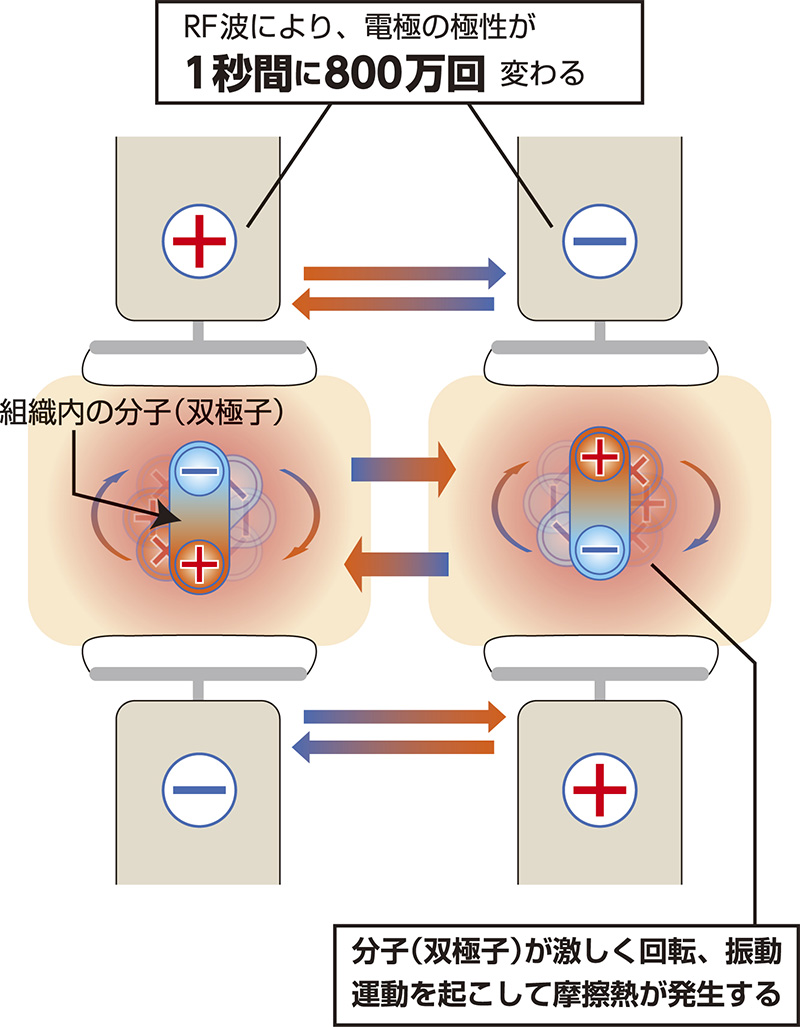 ハイパーサーミアとは